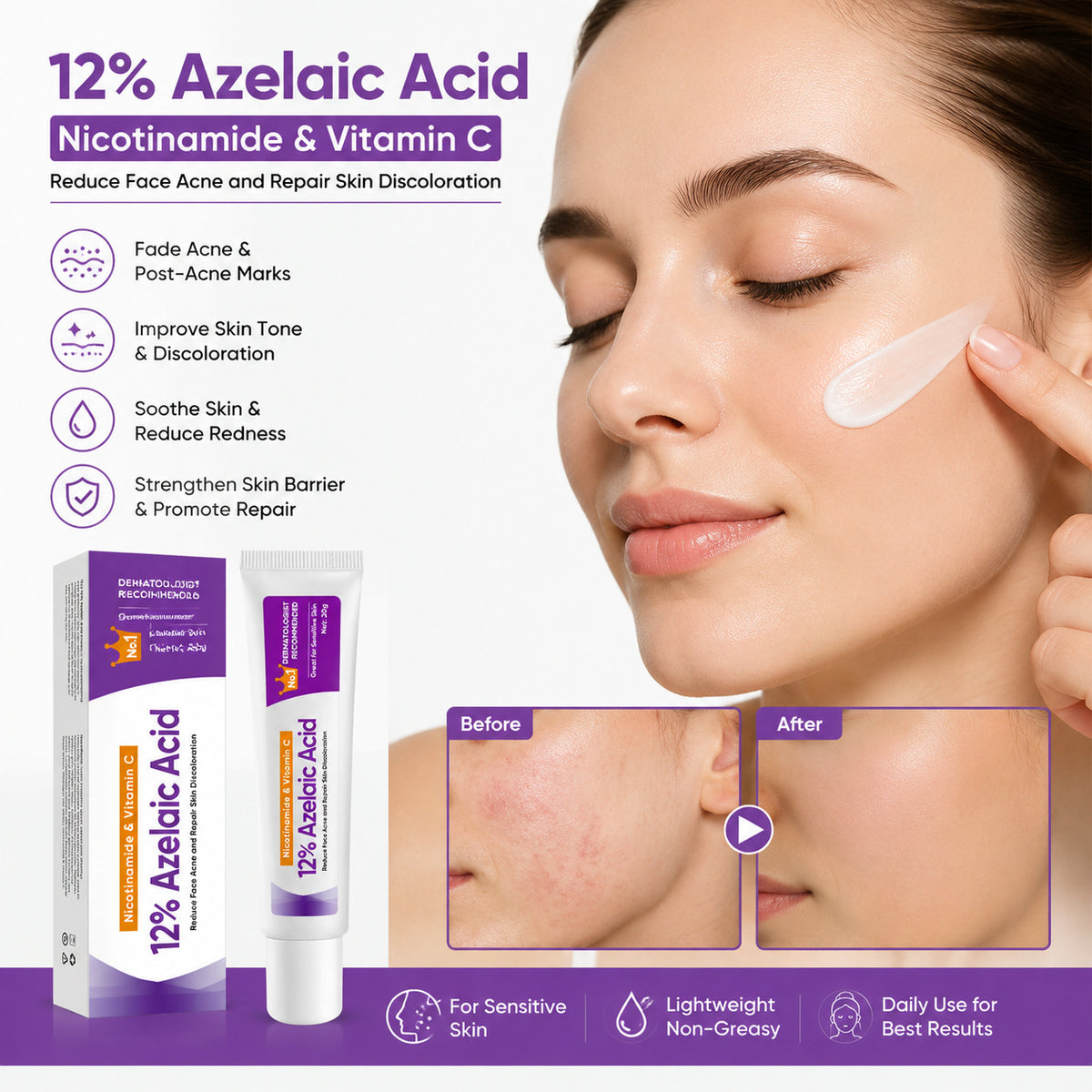 Fades Acne Marks and Removes Acne Ointment