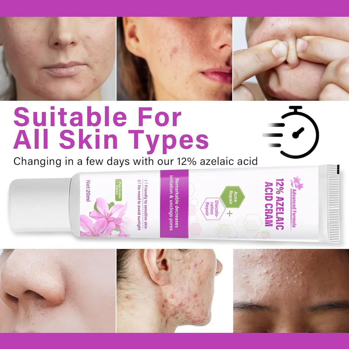 Azelaic Acid Cream Essence with Salicylic Acid